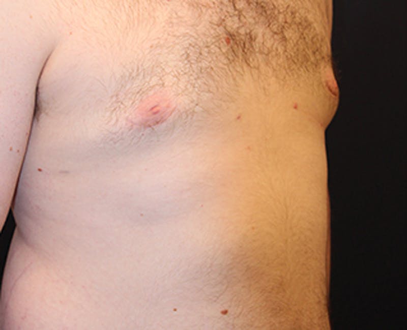Male Breast Reduction/Gynecomastia Before & After Gallery - Patient 174150020 - Image 5