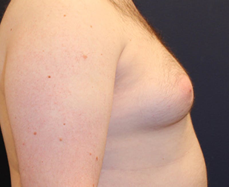 Male Breast Reduction/Gynecomastia Before & After Gallery - Patient 174150020 - Image 6