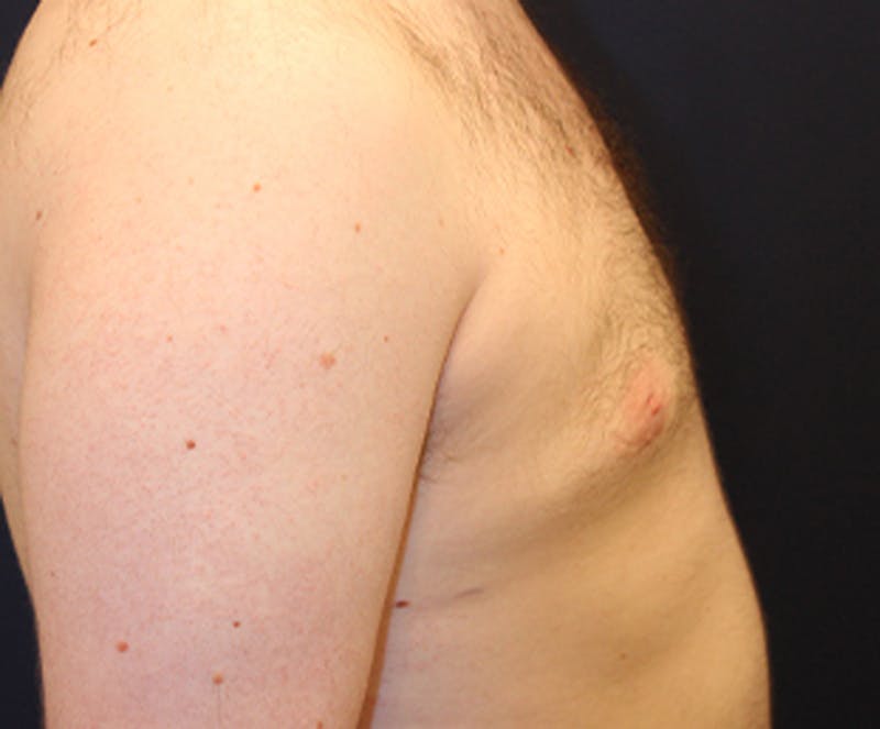 Male Breast Reduction/Gynecomastia Before & After Gallery - Patient 174150020 - Image 7
