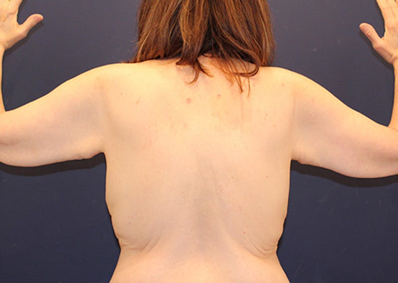 Arm Lift Before & After Gallery - Patient 174150019 - Image 1