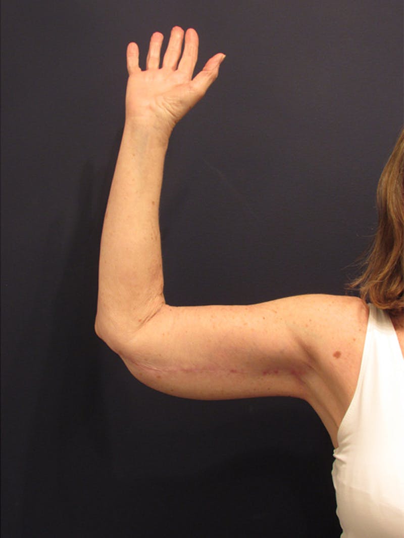 Arm Lift Before & After Gallery - Patient 174150024 - Image 4