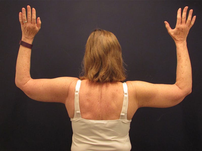 Arm Lift Before & After Gallery - Patient 174150024 - Image 2