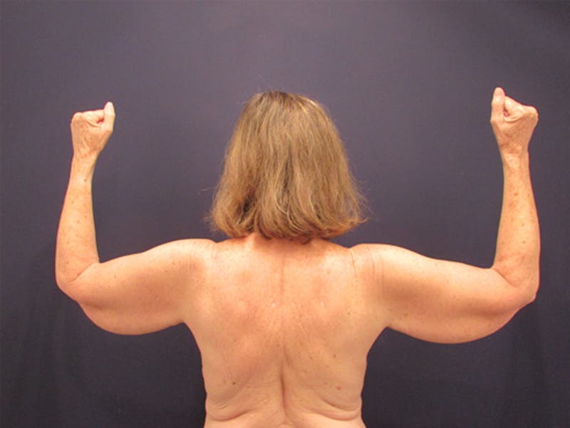 Arm Lift Before & After Gallery - Patient 174150024 - Image 1