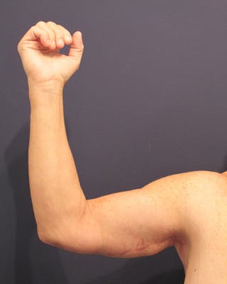 Arm Lift Before & After Gallery - Patient 174150029 - Image 4