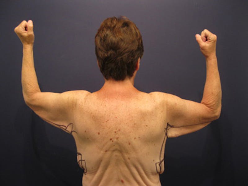 Arm Lift Before & After Gallery - Patient 174150029 - Image 1