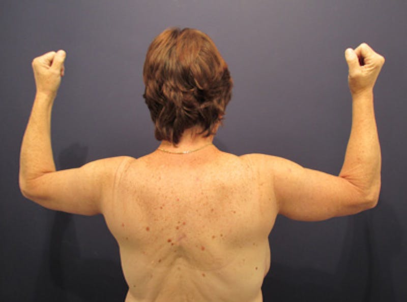 Arm Lift Before & After Gallery - Patient 174150029 - Image 2