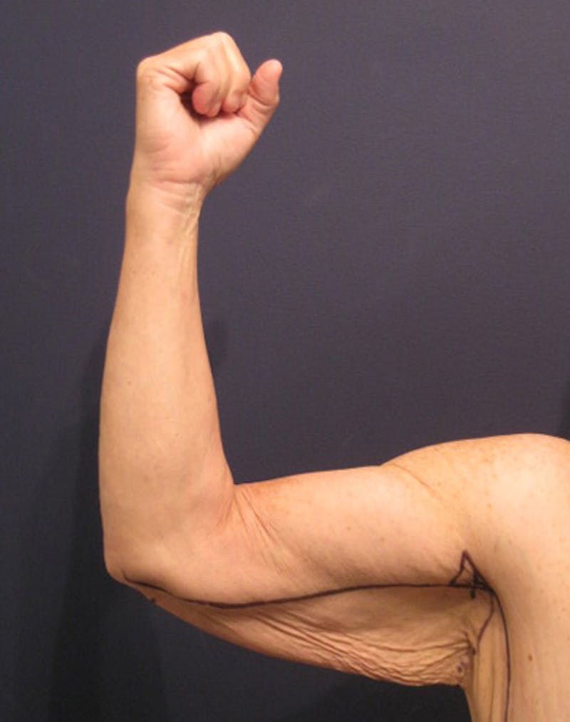 Arm Lift Before & After Gallery - Patient 174150029 - Image 3
