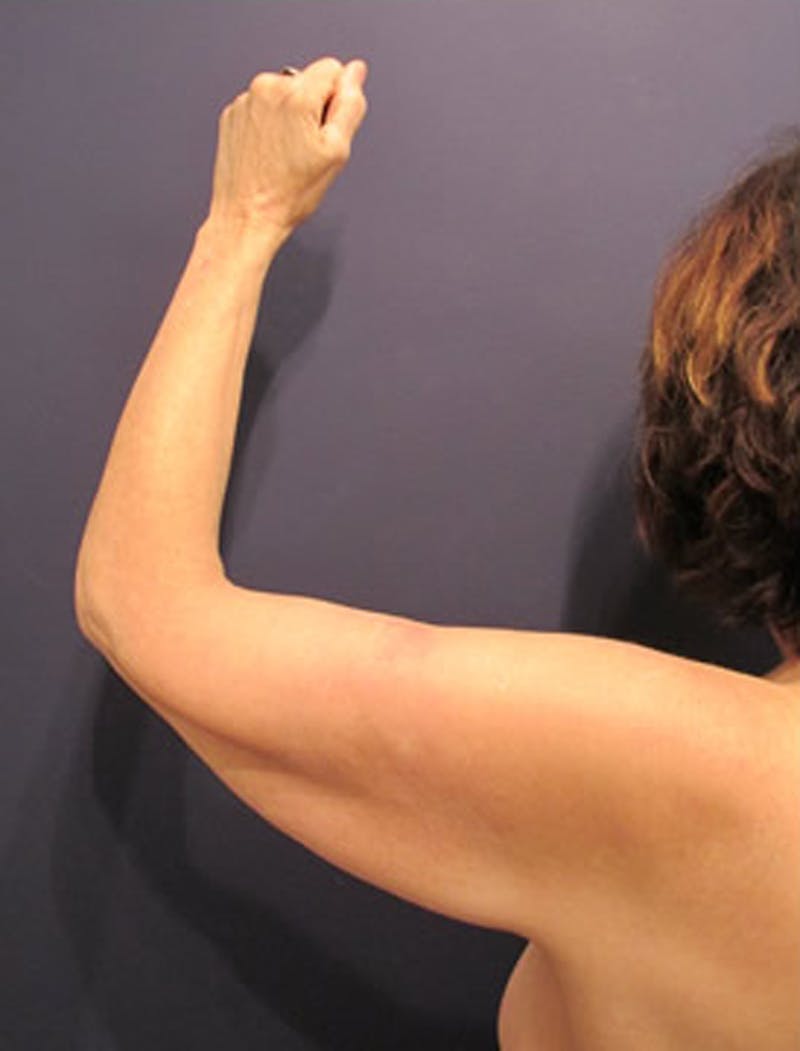 Arm Lift Before & After Gallery - Patient 174150034 - Image 3