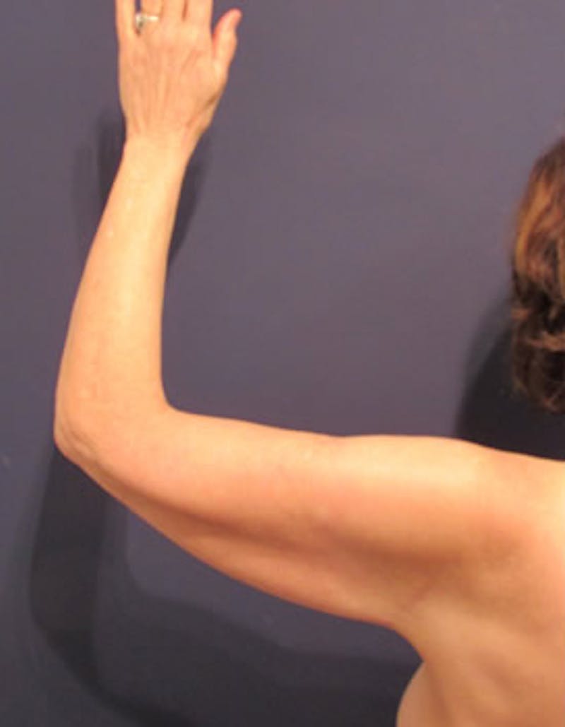 Arm Lift Before & After Gallery - Patient 174150034 - Image 4