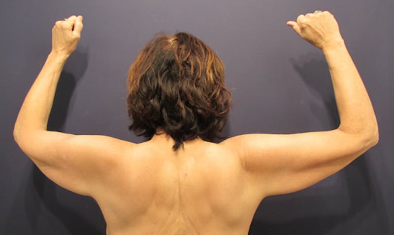 Arm Lift Before & After Gallery - Patient 174150034 - Image 1