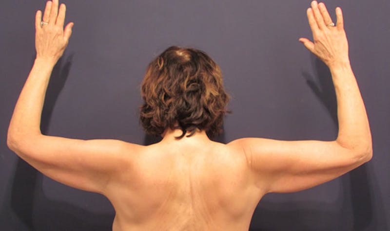Arm Lift Before & After Gallery - Patient 174150034 - Image 2