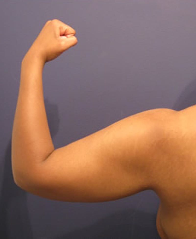 Arm Lift Before & After Gallery - Patient 174160944 - Image 3