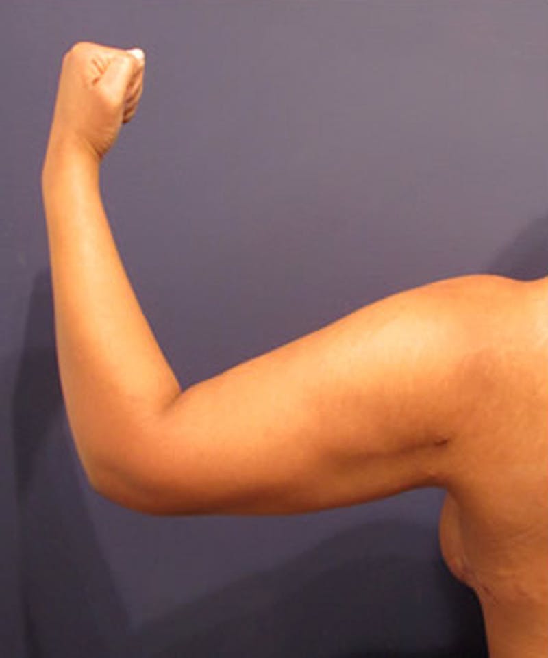 Arm Lift Before & After Gallery - Patient 174160944 - Image 4