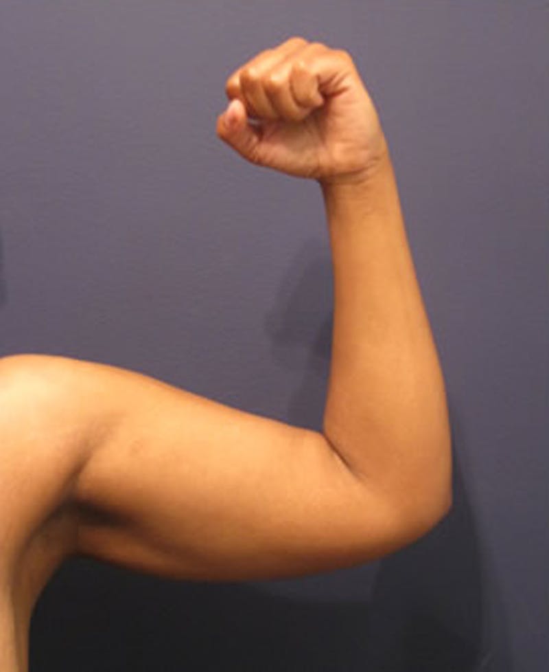 Arm Lift Before & After Gallery - Patient 174160944 - Image 5