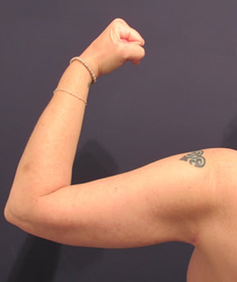 Arm Lift Before & After Gallery - Patient 174160948 - Image 6