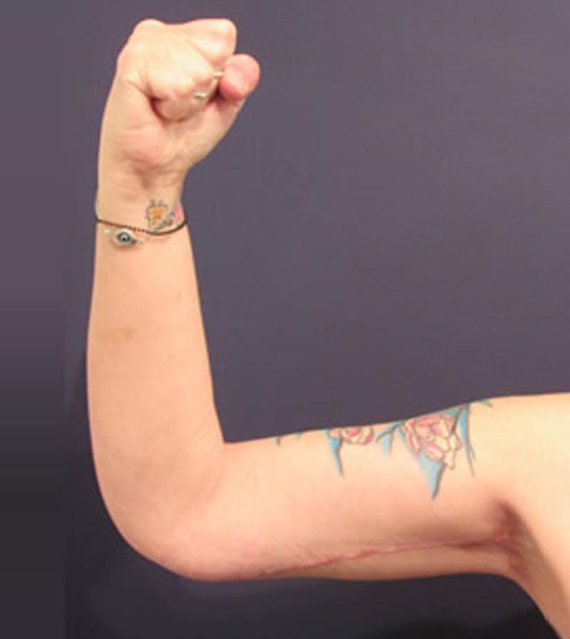 Arm Lift Before & After Gallery - Patient 174160948 - Image 4