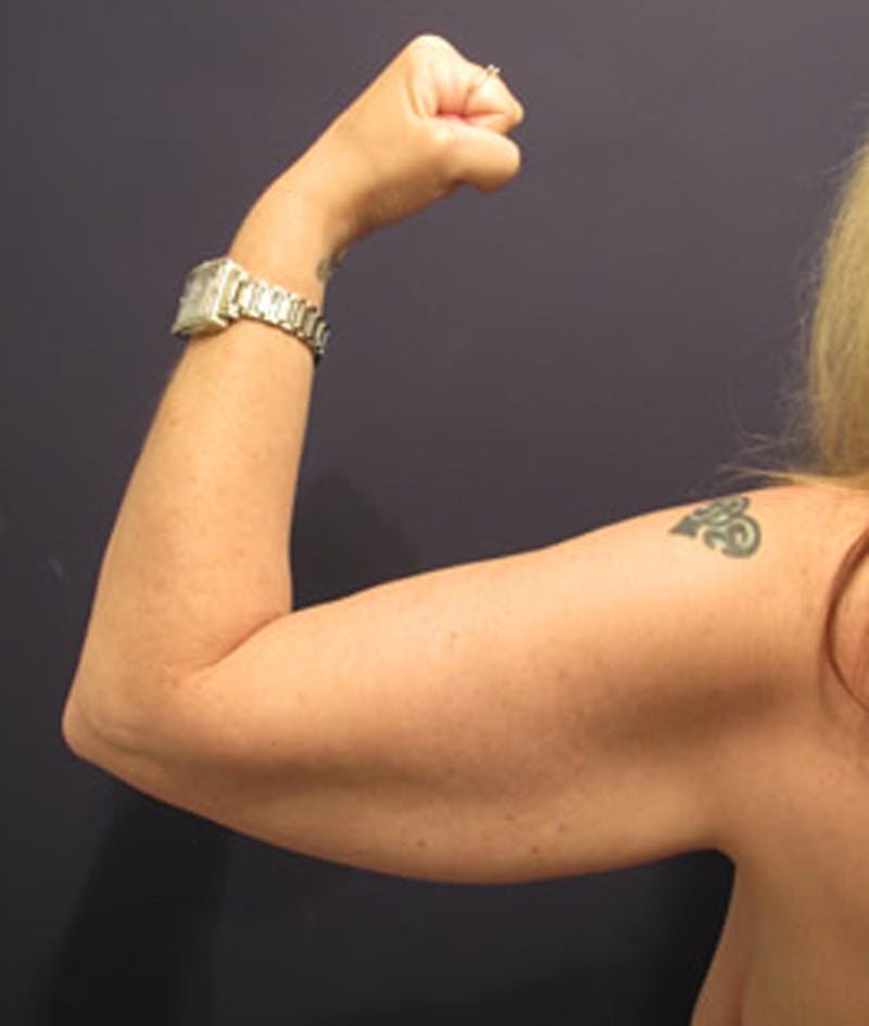 Arm Lift Before & After Gallery - Patient 174160948 - Image 5