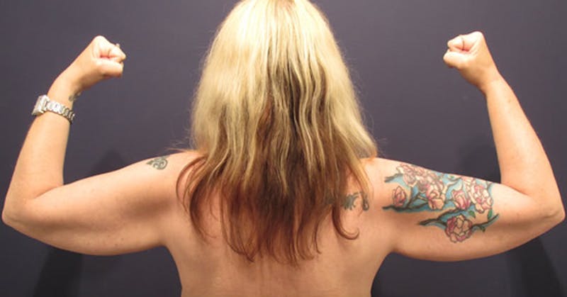 Arm Lift Before & After Gallery - Patient 174160948 - Image 1