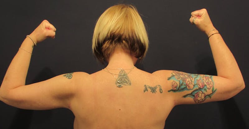 Arm Lift Before & After Gallery - Patient 174160948 - Image 2
