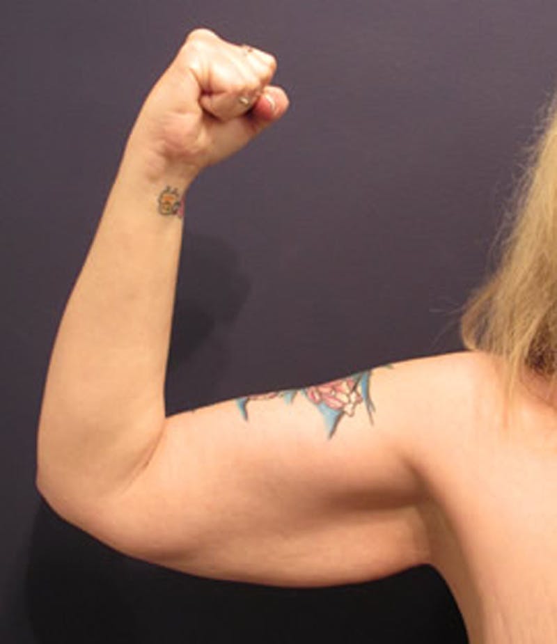 Arm Lift Before & After Gallery - Patient 174160948 - Image 3