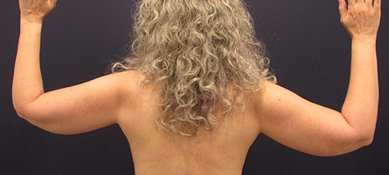 Arm Lift Before & After Gallery - Patient 174160955 - Image 1