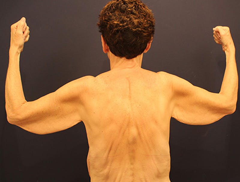 Arm Lift Before & After Gallery - Patient 174160962 - Image 1