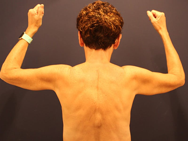 Arm Lift Before & After Gallery - Patient 174160962 - Image 2