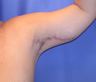 Arm Lift Before & After Gallery - Patient 174160968 - Image 4