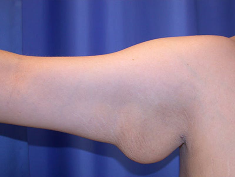 Arm Lift Before & After Gallery - Patient 174160968 - Image 1