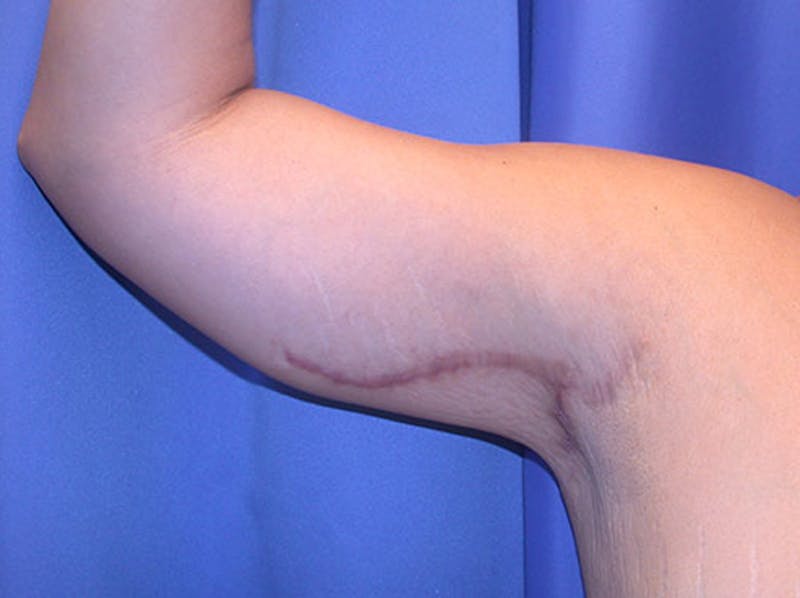 Arm Lift Before & After Gallery - Patient 174160968 - Image 2