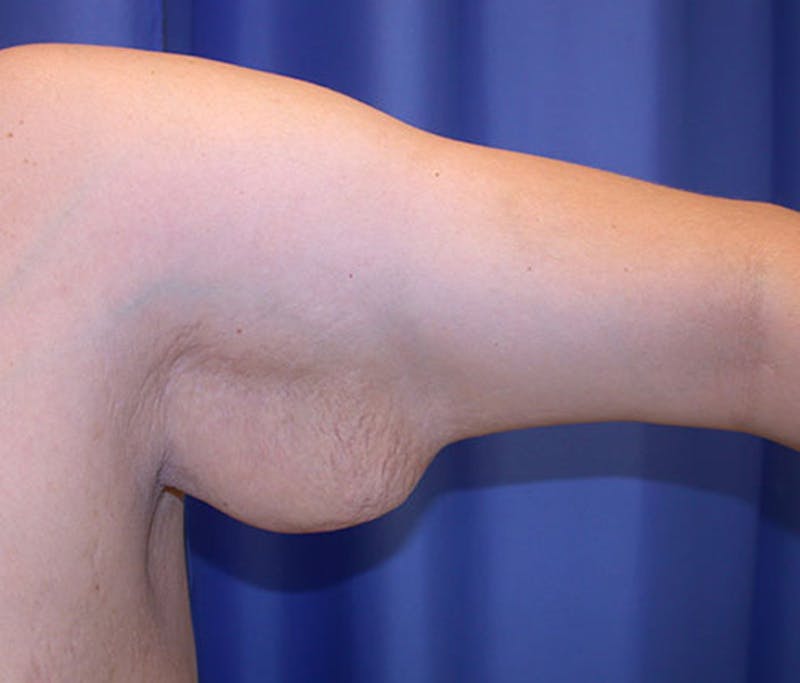 Arm Lift Before & After Gallery - Patient 174160968 - Image 3