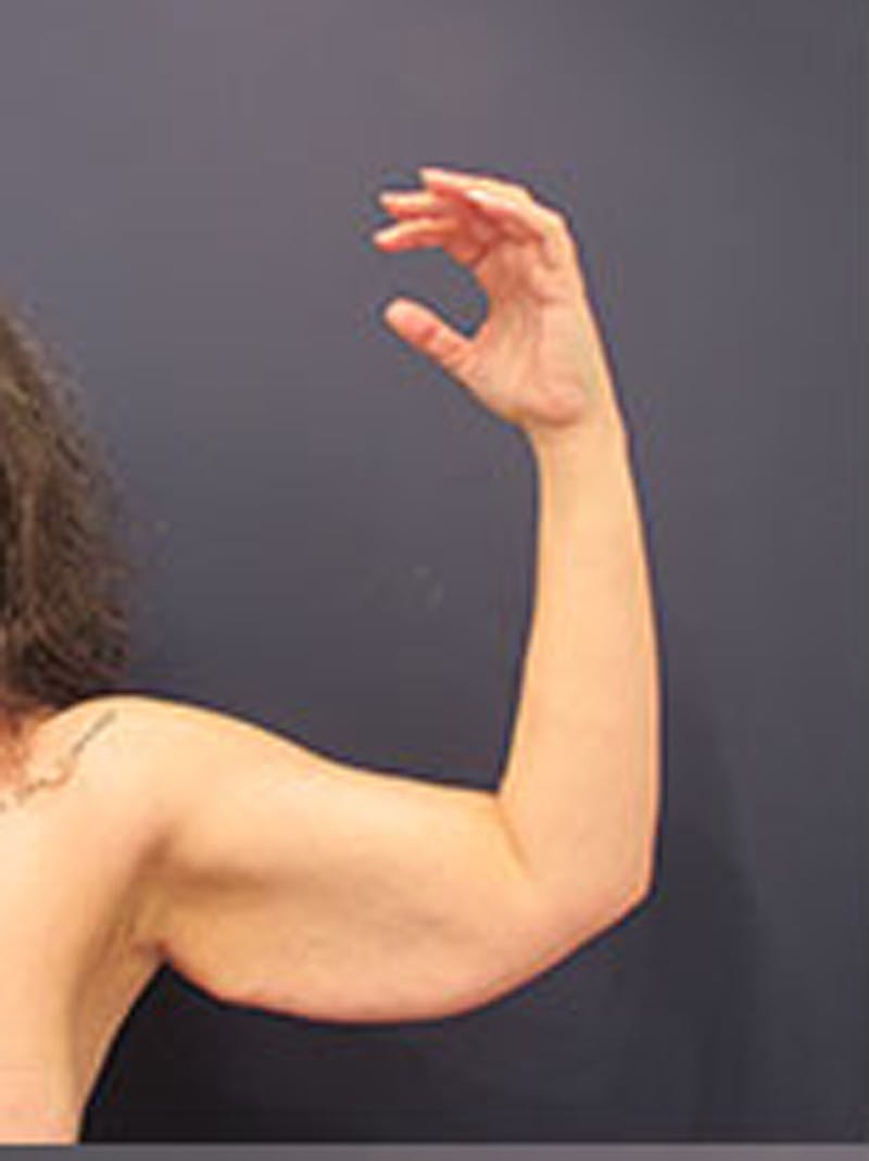 Arm Lift Before & After Gallery - Patient 174160972 - Image 3