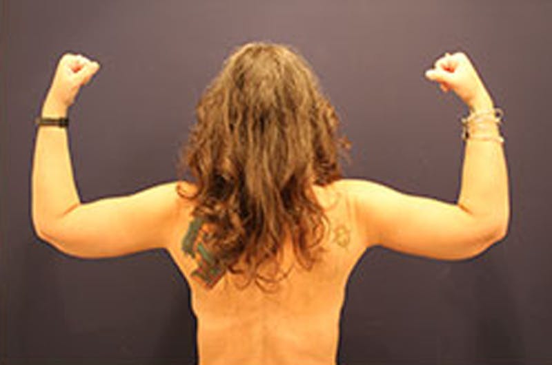 Arm Lift Before & After Gallery - Patient 174160972 - Image 2