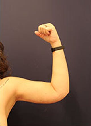 Arm Lift Before & After Gallery - Patient 174160972 - Image 4