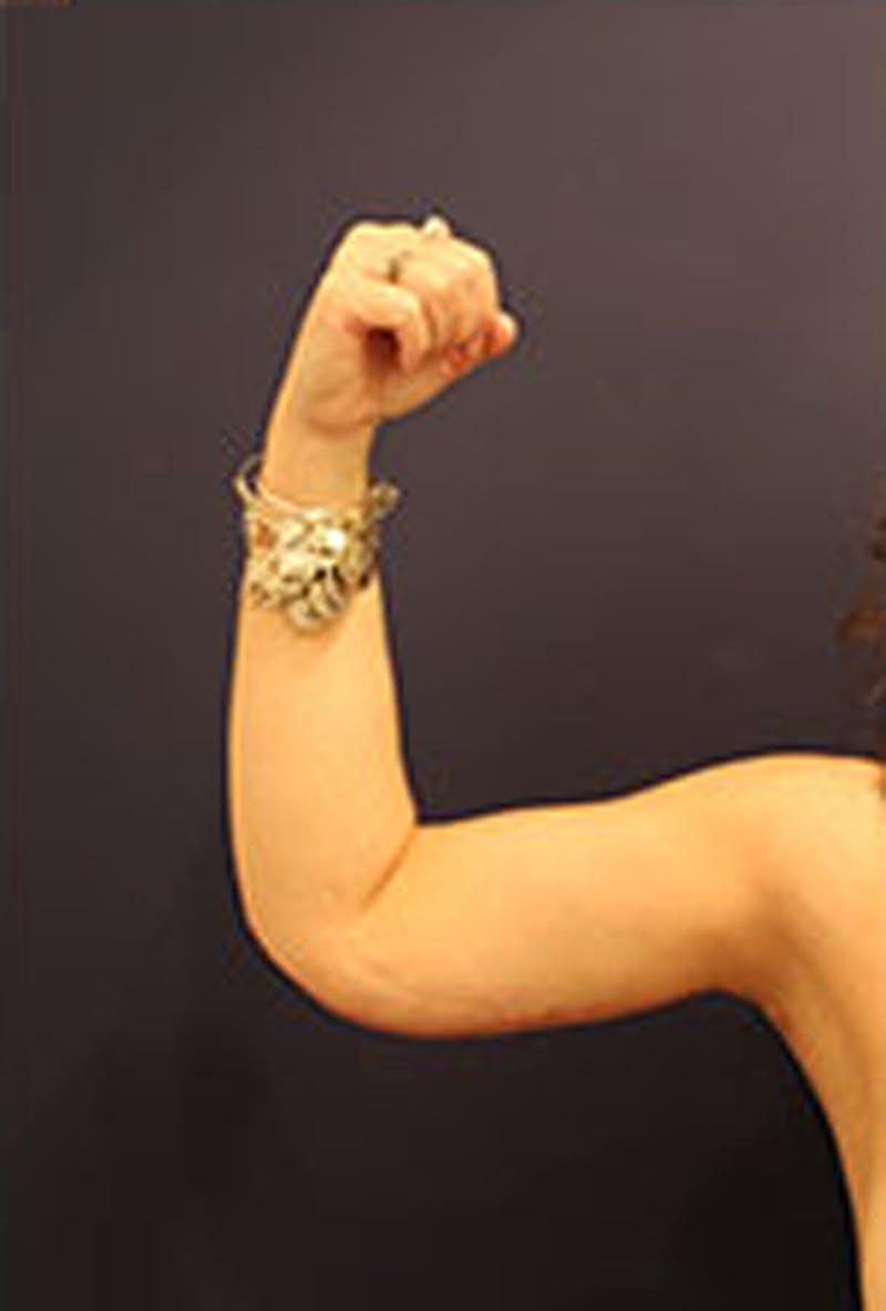 Arm Lift Before & After Gallery - Patient 174160972 - Image 6