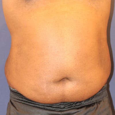 Emsculpt Neo Before & After Gallery - Patient 183062084 - Image 1