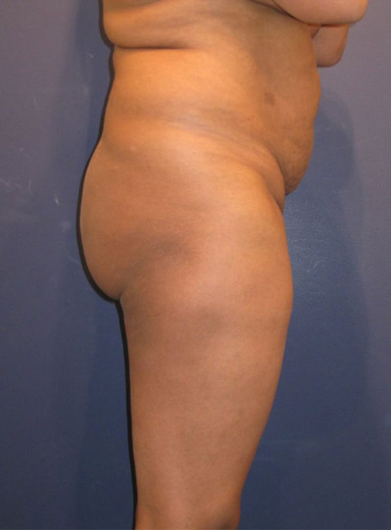 Buttock Fat Transfer Before & After Gallery - Patient 174160954 - Image 1