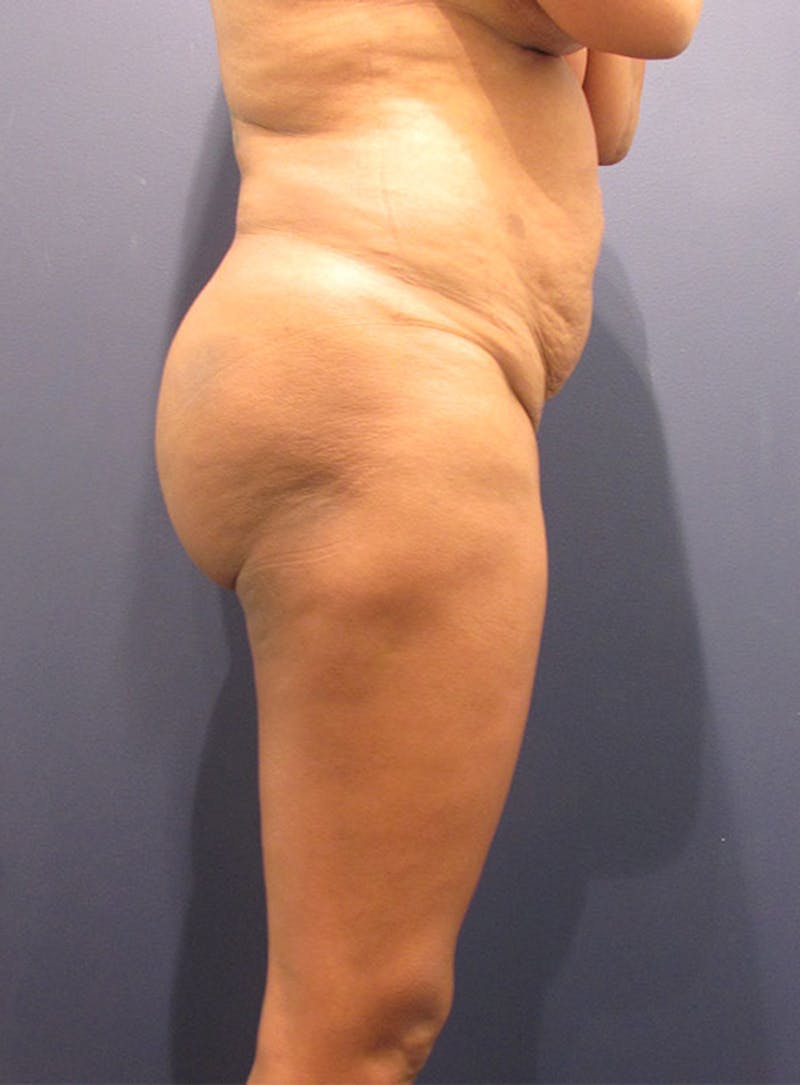 Buttock Fat Transfer Before & After Gallery - Patient 174160954 - Image 2