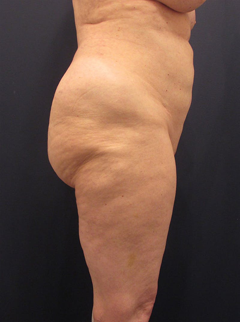 Buttock Fat Transfer Before & After Gallery - Patient 174160958 - Image 1
