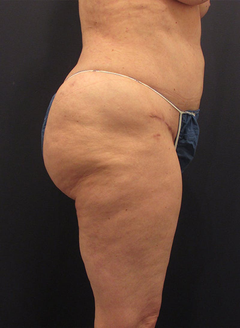 Buttock Fat Transfer Before & After Gallery - Patient 174160958 - Image 2