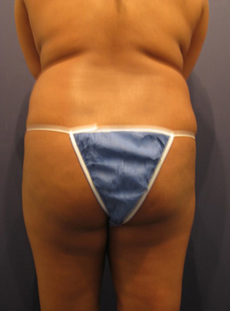 Buttock Fat Transfer Before & After Gallery - Patient 174160965 - Image 1