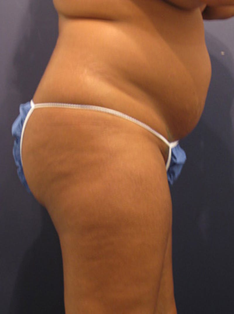 Buttock Fat Transfer Before & After Gallery - Patient 174160965 - Image 3