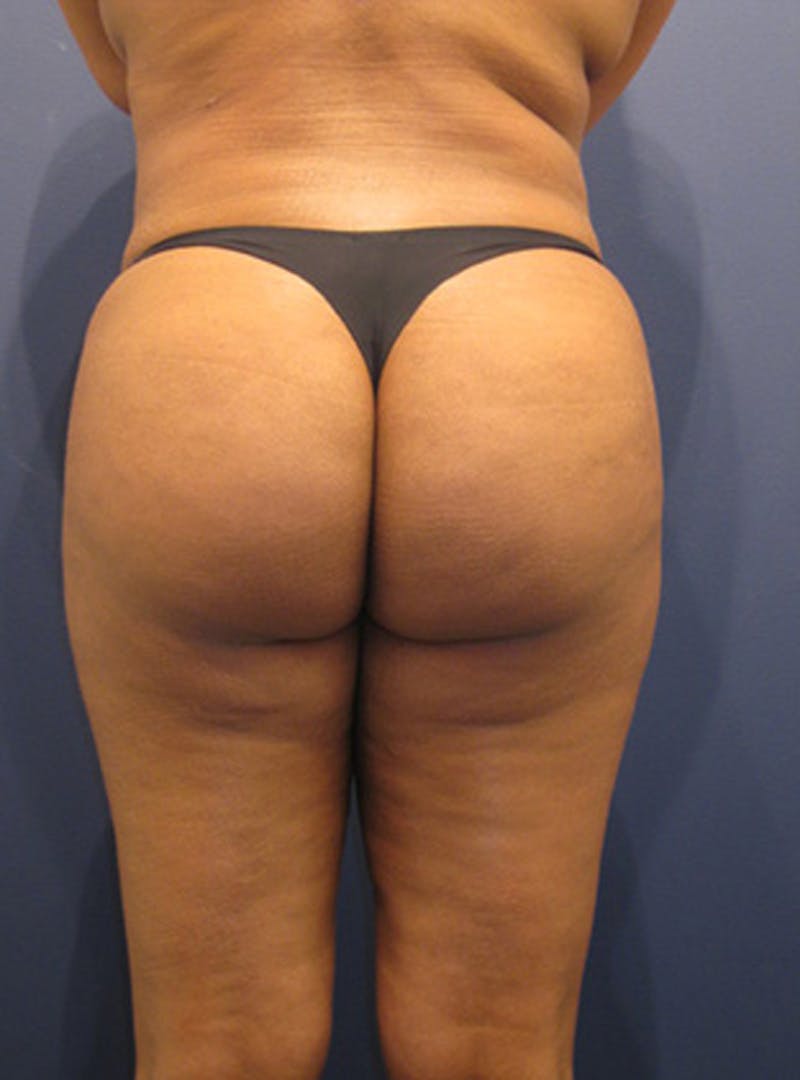 Buttock Fat Transfer Before & After Gallery - Patient 174160965 - Image 2
