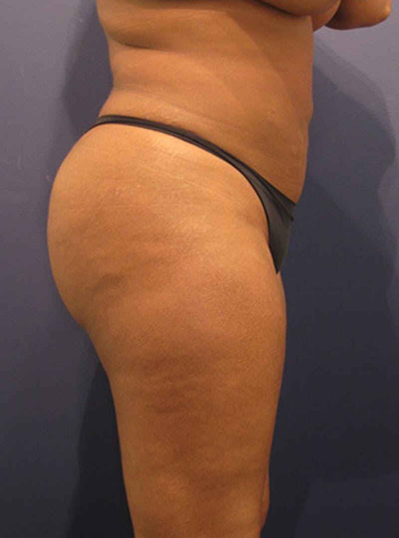 Buttock Fat Transfer Before & After Gallery - Patient 174160965 - Image 4