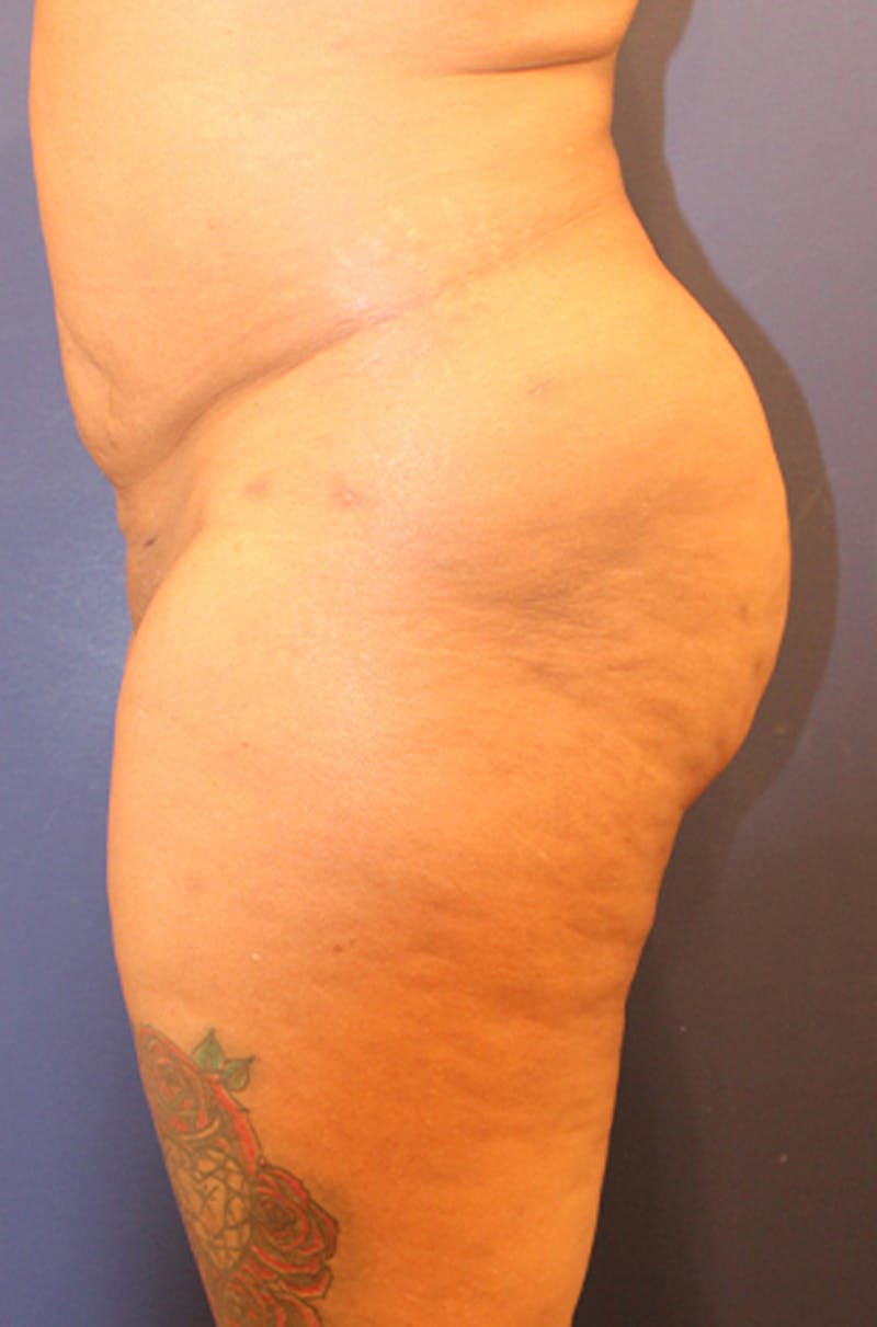Buttock Fat Transfer Before & After Gallery - Patient 174160949 - Image 6