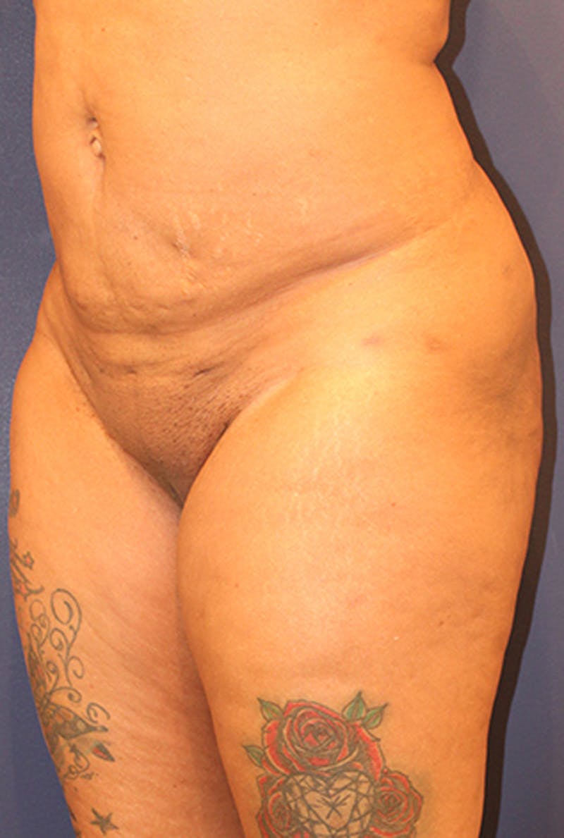 Buttock Fat Transfer Before & After Gallery - Patient 174160949 - Image 4