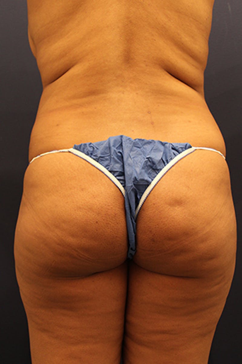 Buttock Fat Transfer Before & After Gallery - Patient 174160942 - Image 1