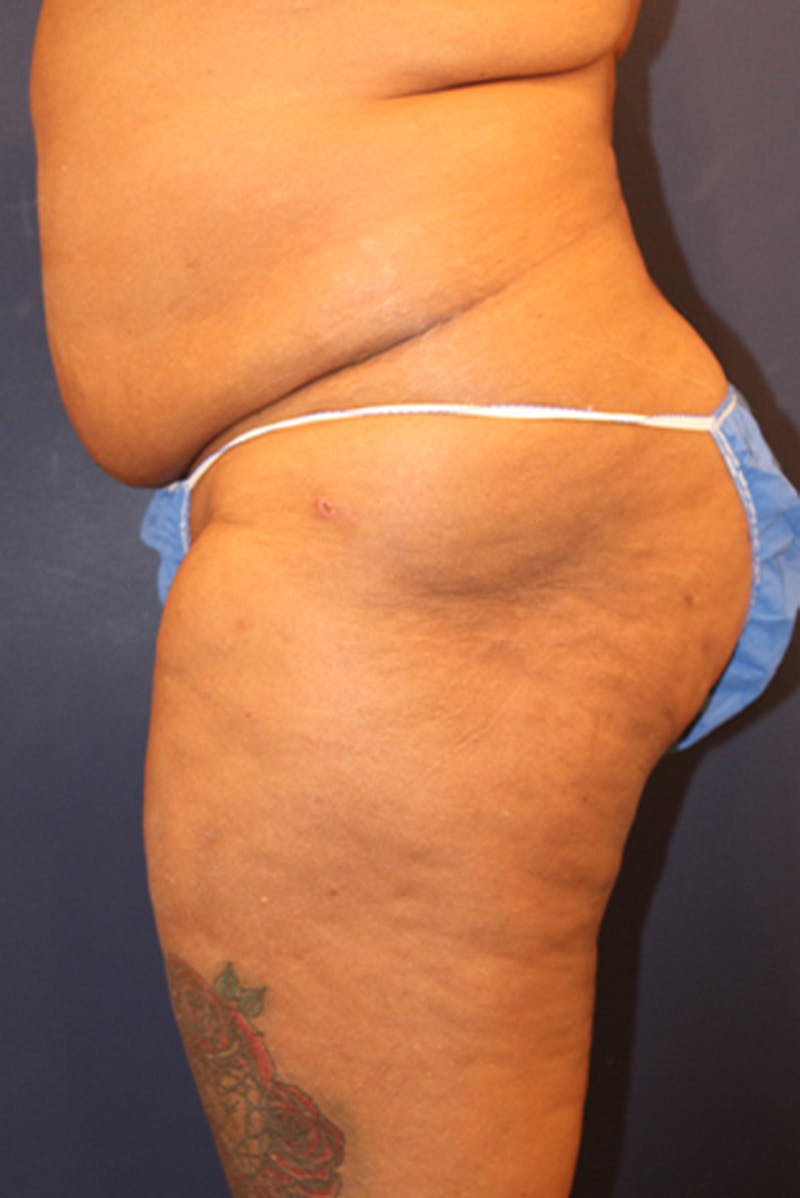 Buttock Fat Transfer Before & After Gallery - Patient 174160949 - Image 5
