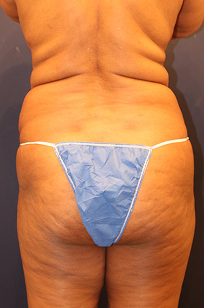 Buttock Fat Transfer Before & After Gallery - Patient 174160949 - Image 1