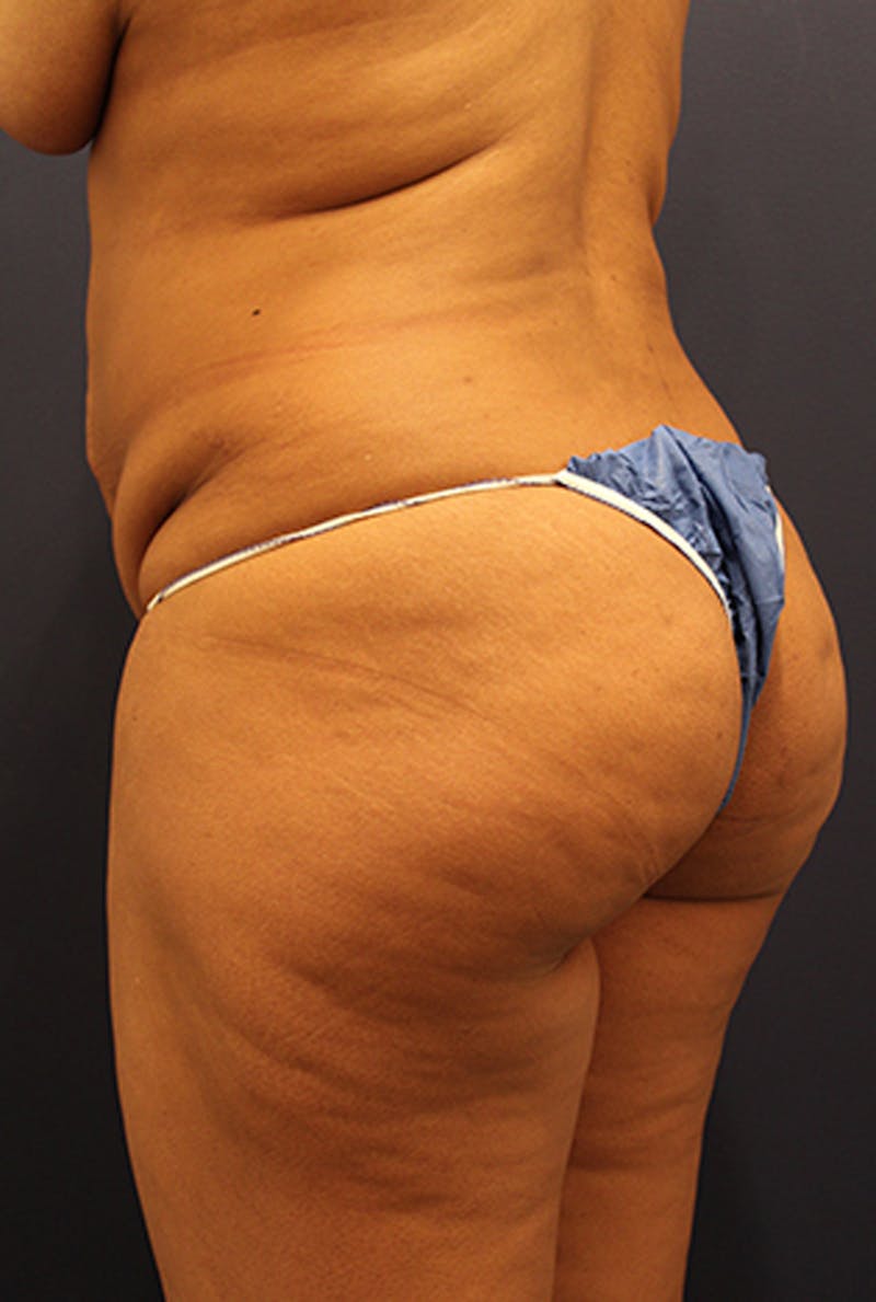 Buttock Fat Transfer Before & After Gallery - Patient 174160942 - Image 3